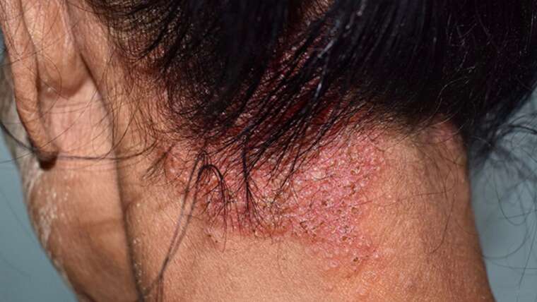 Dermatitis seborreica